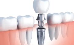 Dental Impact